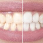 Blanqueamiento dental: el tratamiento estético dental más demandado