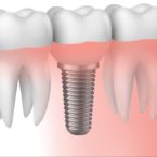 Implantes dentales estrechos