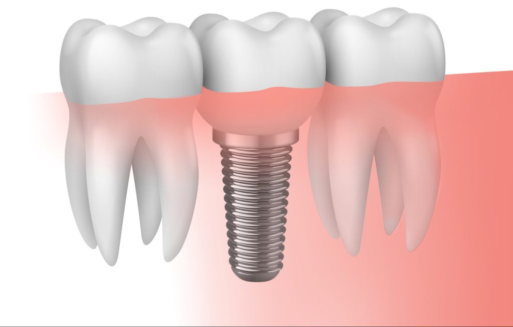 Implantes dentales