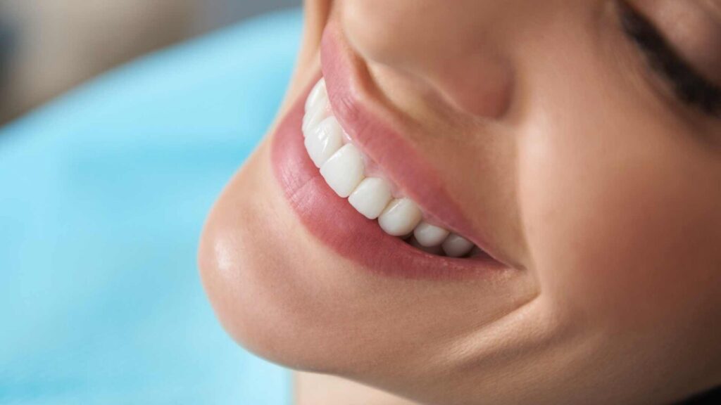 blanqueamiento dental