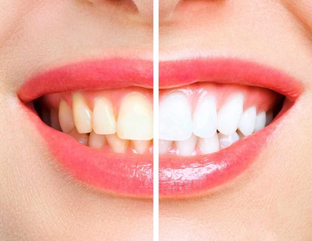 blanqueamiento dental