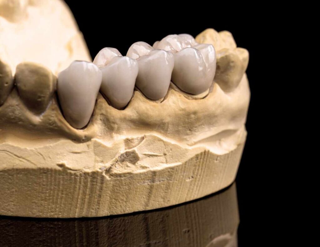 Coronas y puentes dentales