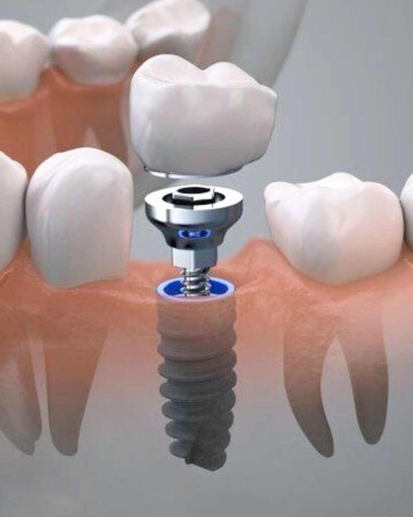 implantes dentales