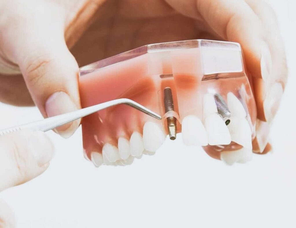 implantes dentales