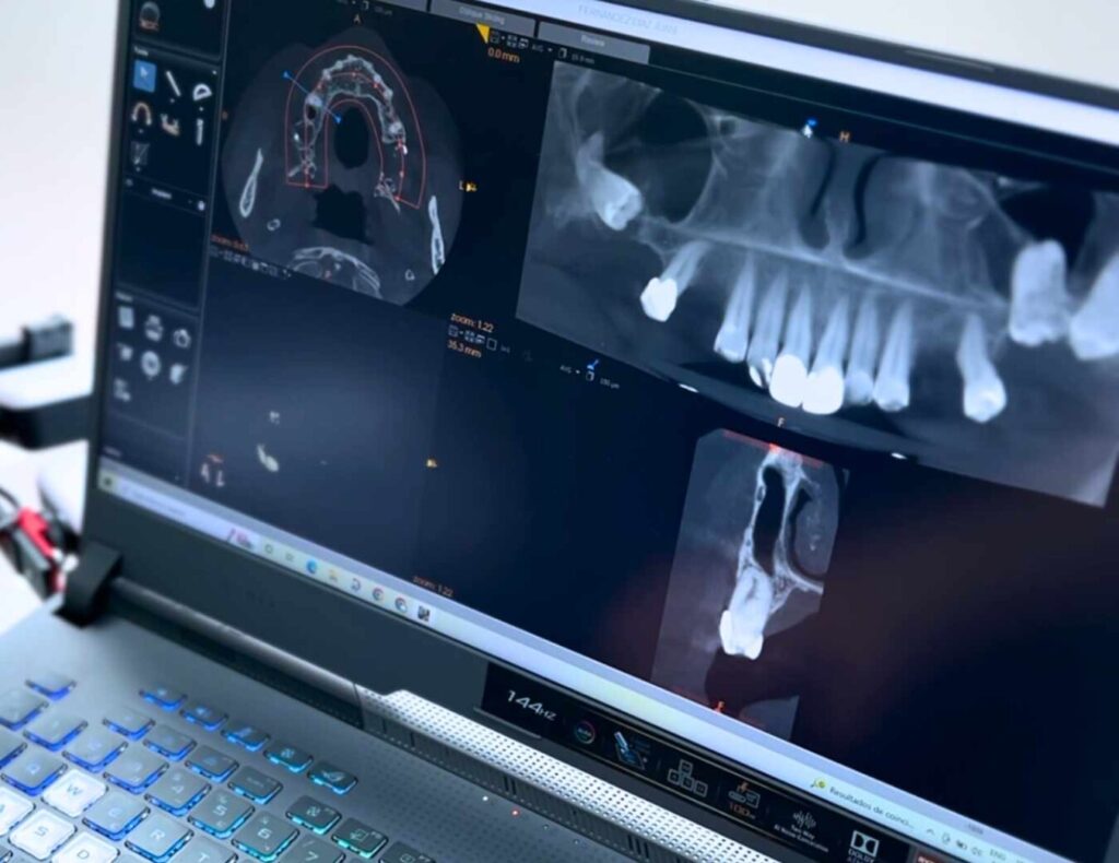 implantes dentales