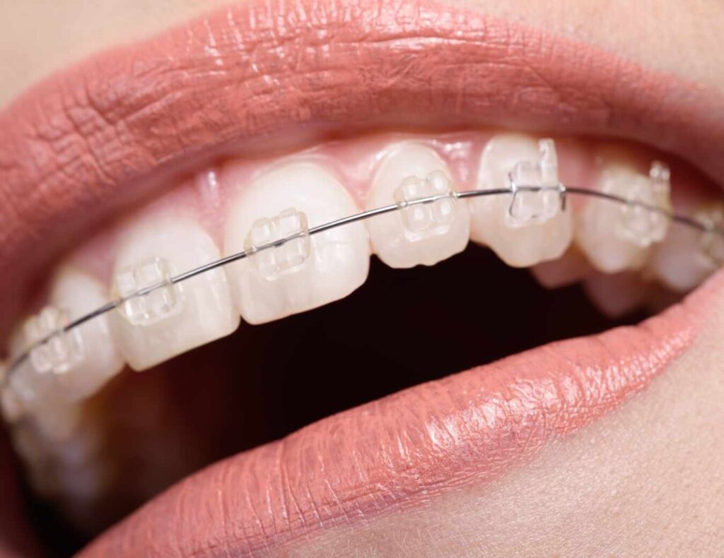 ortodoncia brackets