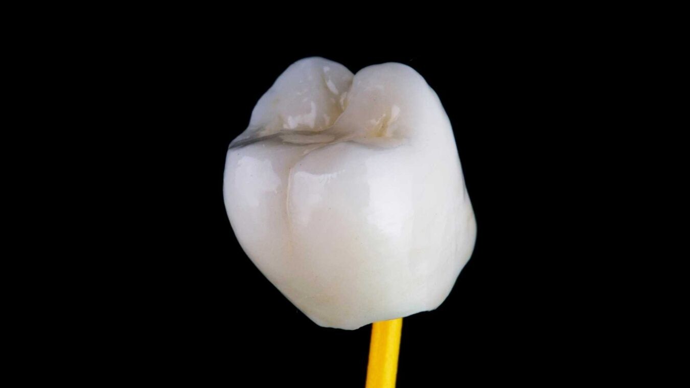 coronas dentales tipos