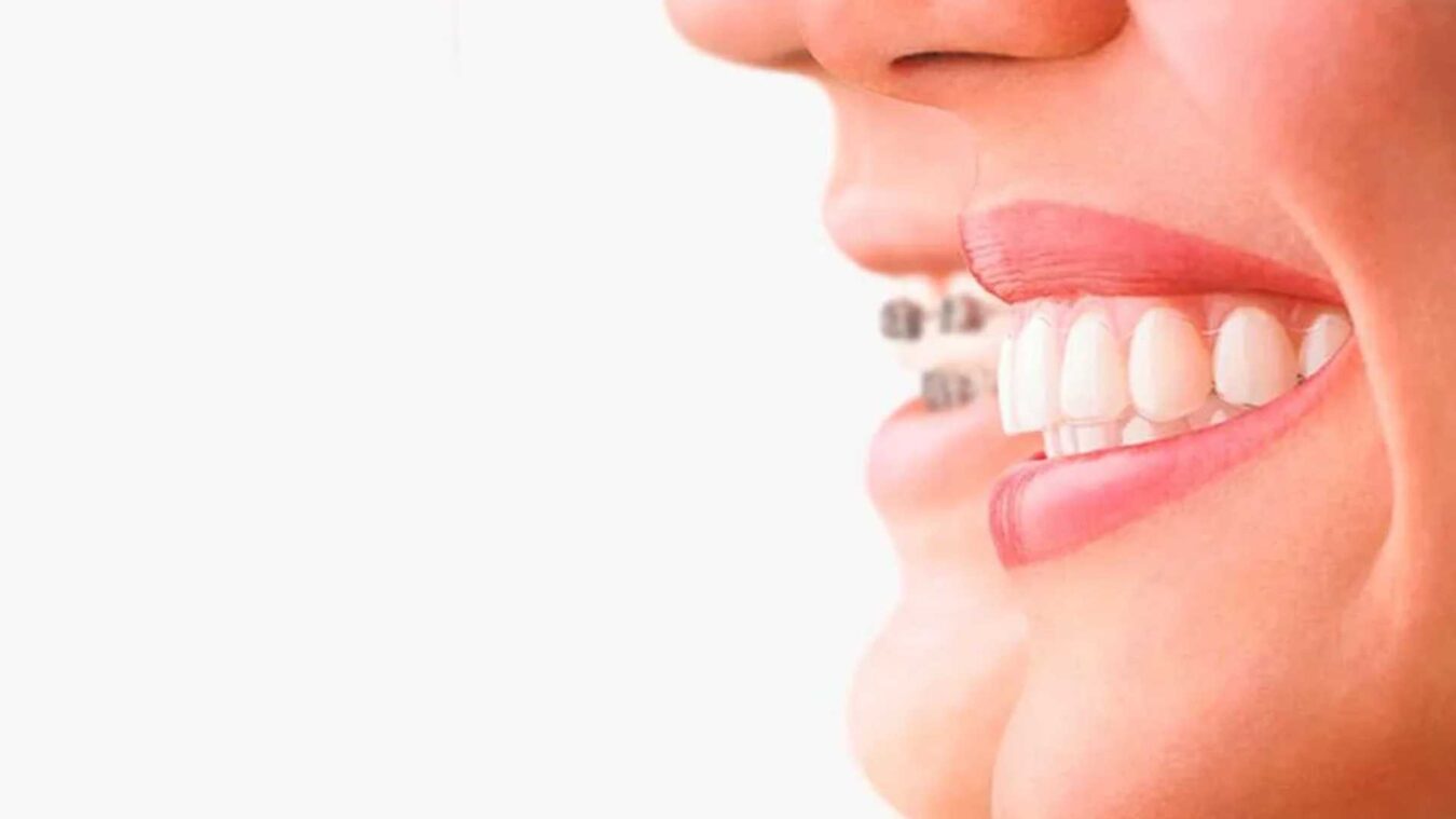 ortodoncia invisible vs brackets