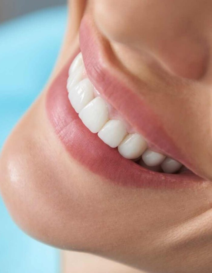 blanqueamiento dental