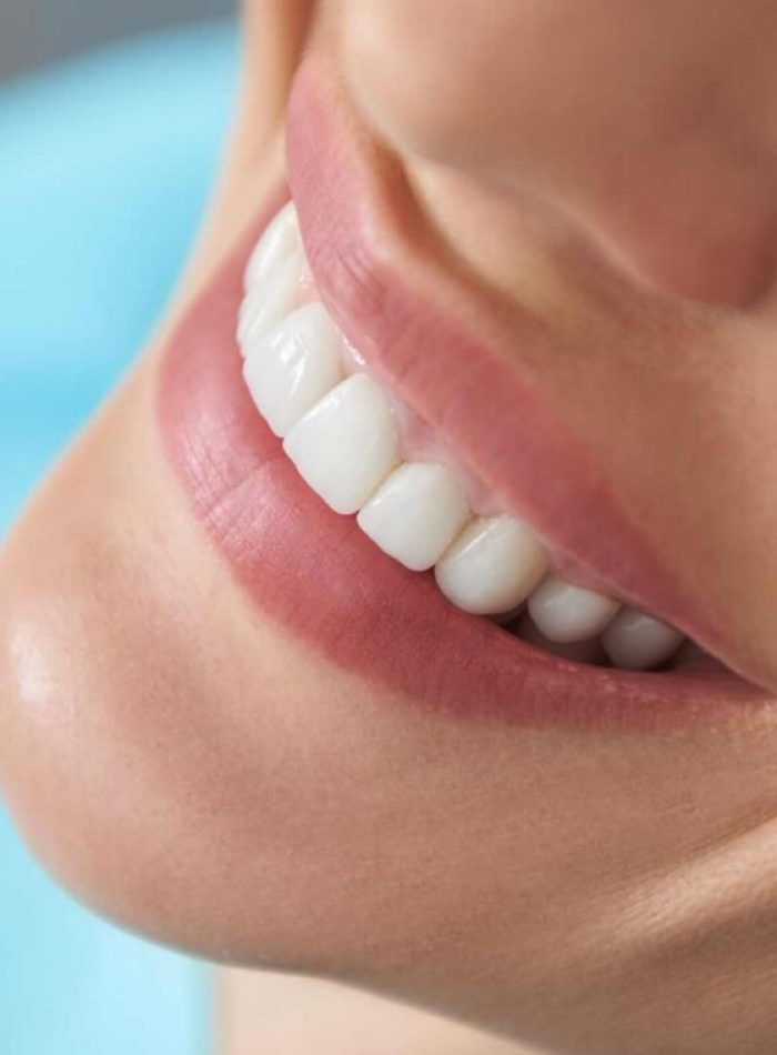 blanqueamiento dental