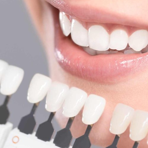 blanqueamiento dental blanqueamiento dental