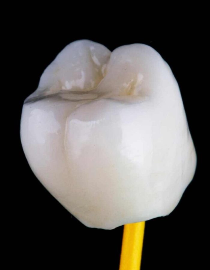 Coronas y puentes dentales