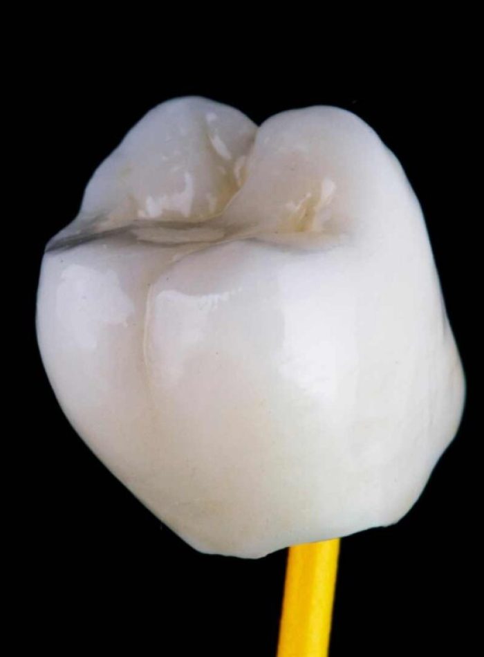 Coronas y puentes dentales