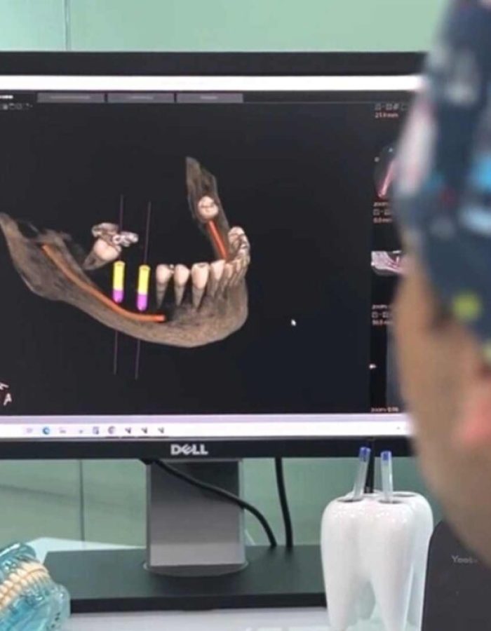 implantes dentales