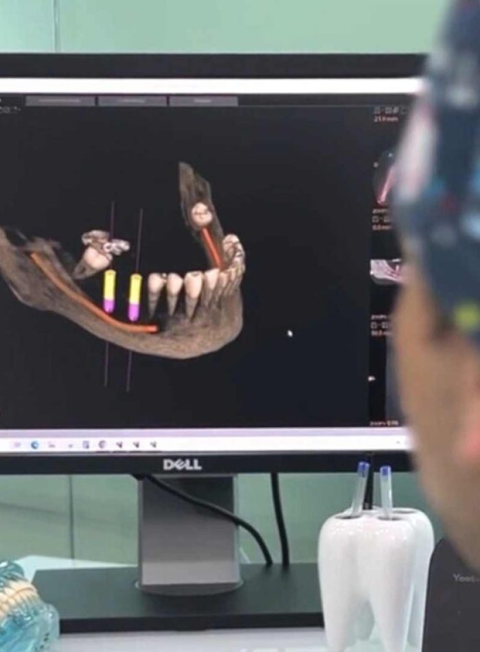 implantes dentales