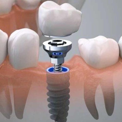 implantes dentales implantes dentales