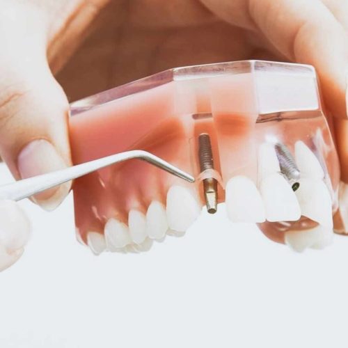 implantes dentales_SIRO_3 implantes dentales