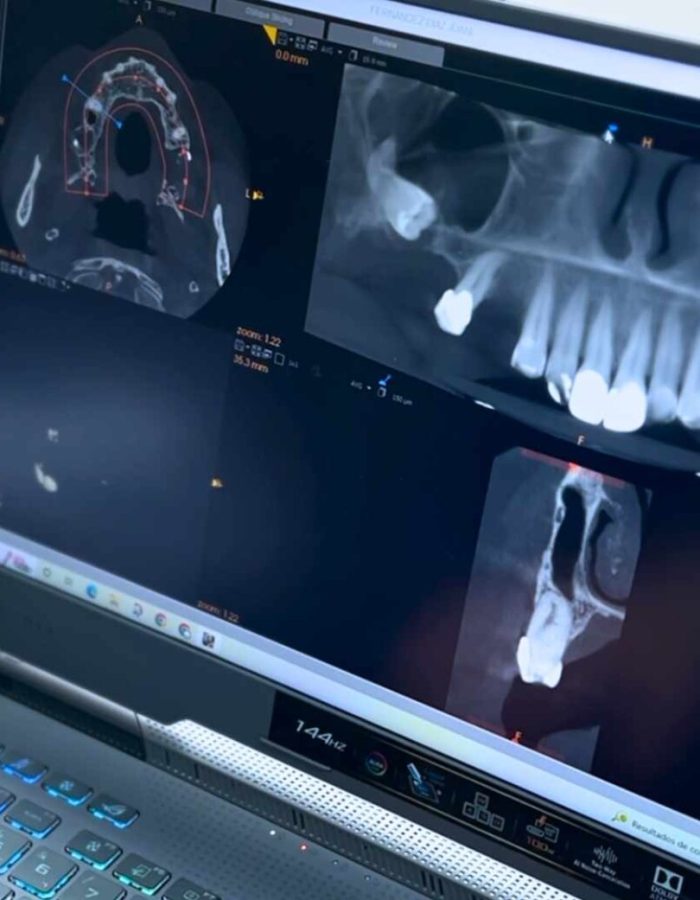 implantes dentales