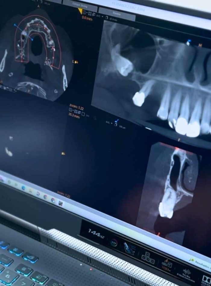 implantes dentales