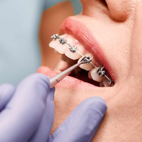 ortodoncia brackets ortodoncia brackets